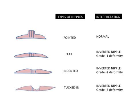 newly inverted nipple|Inverted nipple: Treatment, causes, and pictures